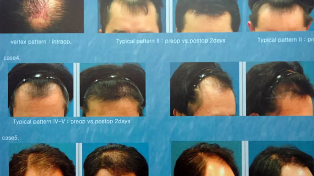 BEFORE AND AFTER Hair Transplant