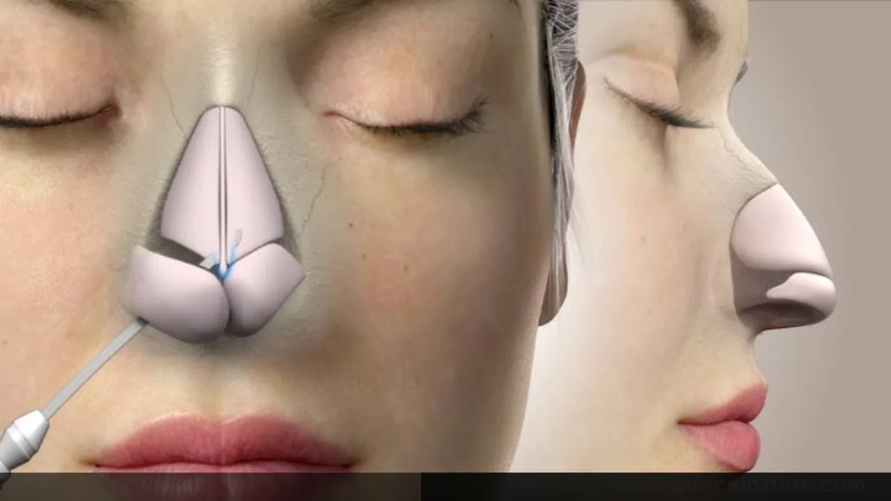 rhinoplasty